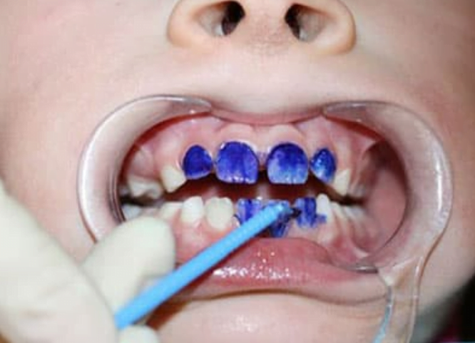 Silver Diamine Fluoride and Dental Sealants: Preventing up to 80% of Cavities in Schoolchildren!