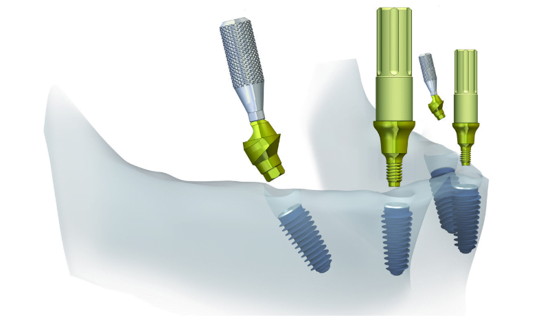 Lower jaw implantation model all on 4® - angled and straight multi-unit abutment placement stage