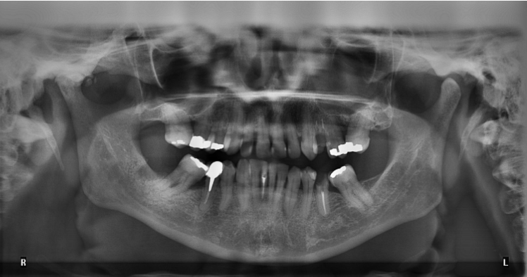 X-ray with synthetic fillings