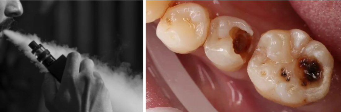 Vaping and dental health: unveiling the hidden risks