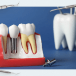 Guided Bone Regeneration (GBR) Part 3  Allogenic and xenogeneic and alloplastic transplants