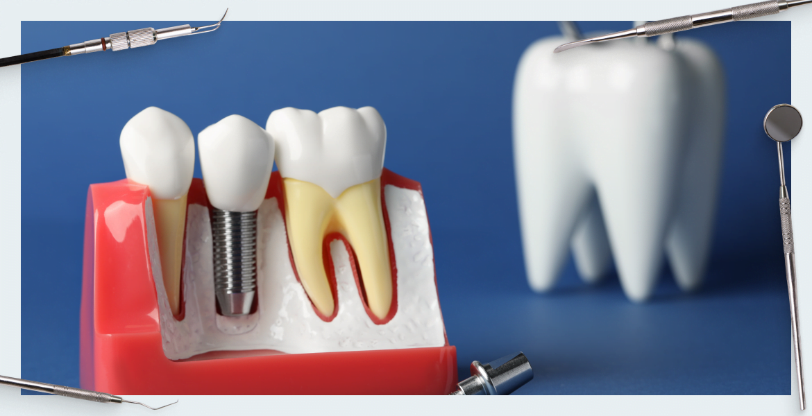 Guided Bone Regeneration (GBR) Part 3 Allogenic and xenogeneic and alloplastic transplants