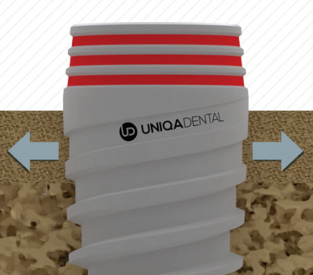 Buy Implants and Accessories for Clinical Cases with Uniqa Dental