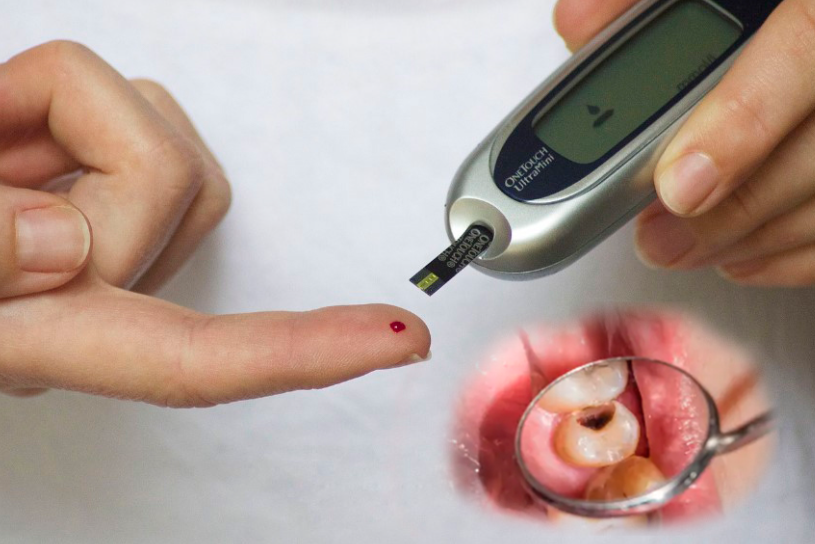 Diabetes increases risk of tooth decay – new research finds