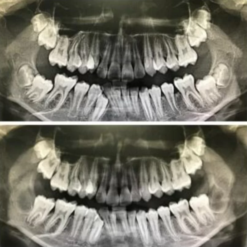 A clinical case where wisdom teeth blocked the growth and normal eruption of second molars.