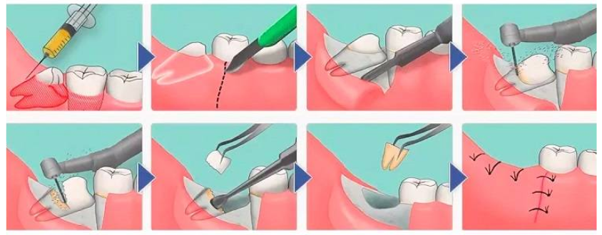 The classic sequence for the extraction of a semi-retained wisdom tooth