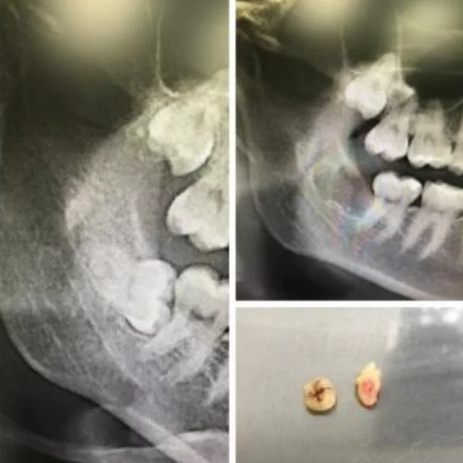 Before and after pictures of a successful wisdom tooth extraction