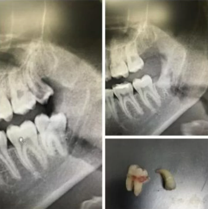 Clinical case of wisdom tooth extraction with a hooked root
