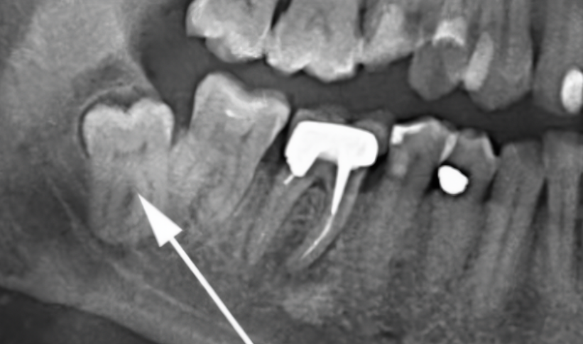 Retained and simultaneously displaced wisdom tooth