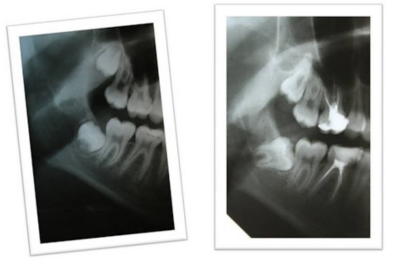 Indications for removal - a retained wisdom tooth that has begun to rotate into a horizontal position.