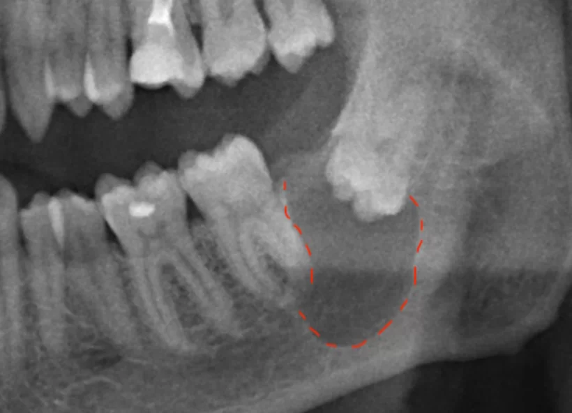 Extensive cyst caused by a retained wisdom tooth.