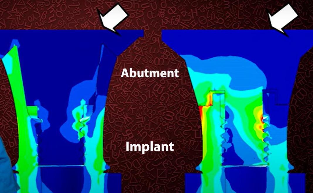 Visualization of load distribution and local overloading of flat and conical implant/abutment interfaces 
