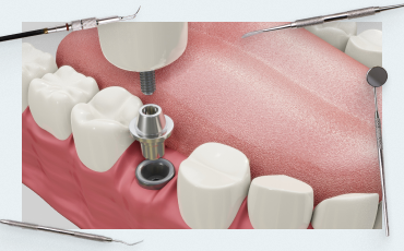 How the implant/abutment connection affects soft tissue integration and marginal bone loss
