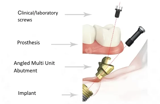 Diagram of a dental implant system with labeled parts: a dental prosthesis (teeth), clinical/laboratory screws, an angled multi-unit abutment, and the implant embedded in the gum.