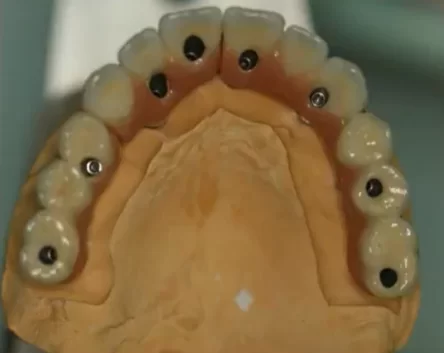 Dental prosthesis on a model showing upper teeth with multiple abutments visible in the gums, prepared for attachment to implants.