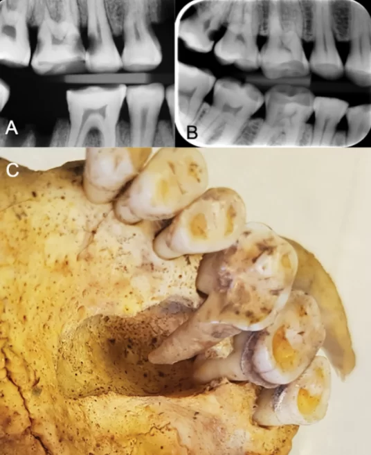 Dental x-rays and a physical specimen showcasing viking age dental conditions