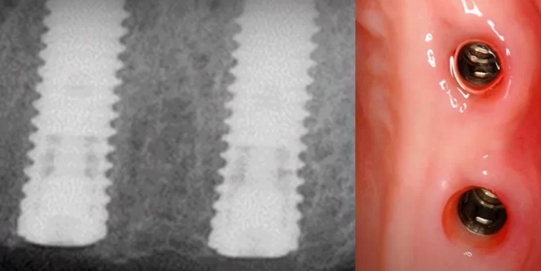 Subcrestal implant placement and soft tissue integration subcrestal implant placement and soft tissue integration 14