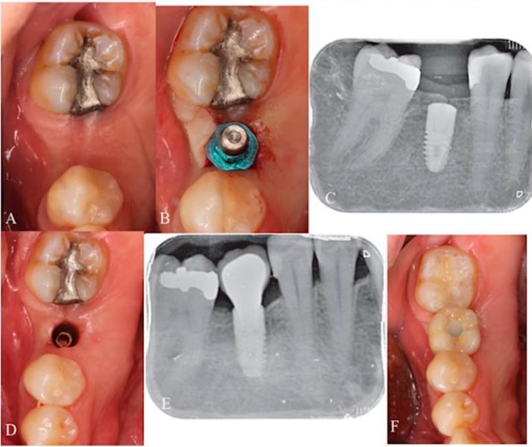 Subcrestal implant installation under experimental conditions 