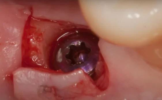 Subcrestal implant placement in a patient with thin gingiva