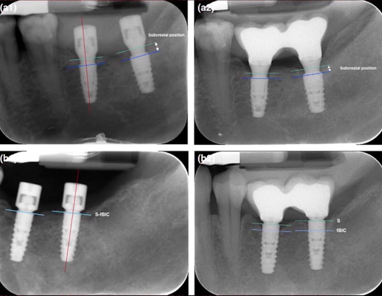 X-rays of implants installed at different depths and abutments of different shapes