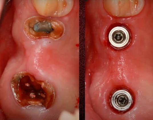 The cavities of the teeth that were extracted and the implants installed in their place