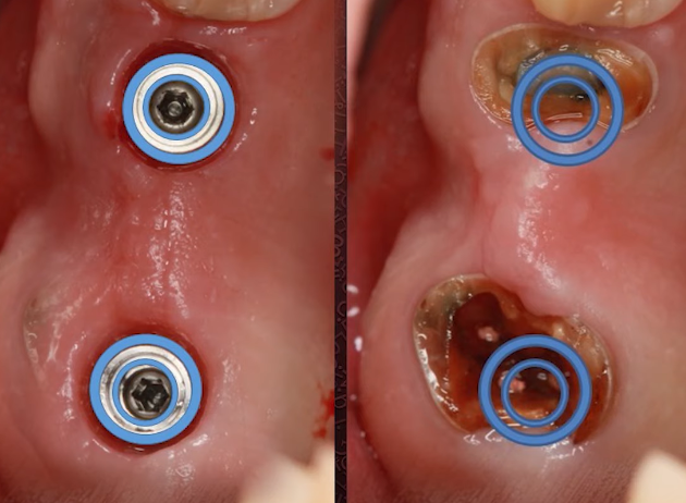 Comparison of implant size with the wells after tooth extraction