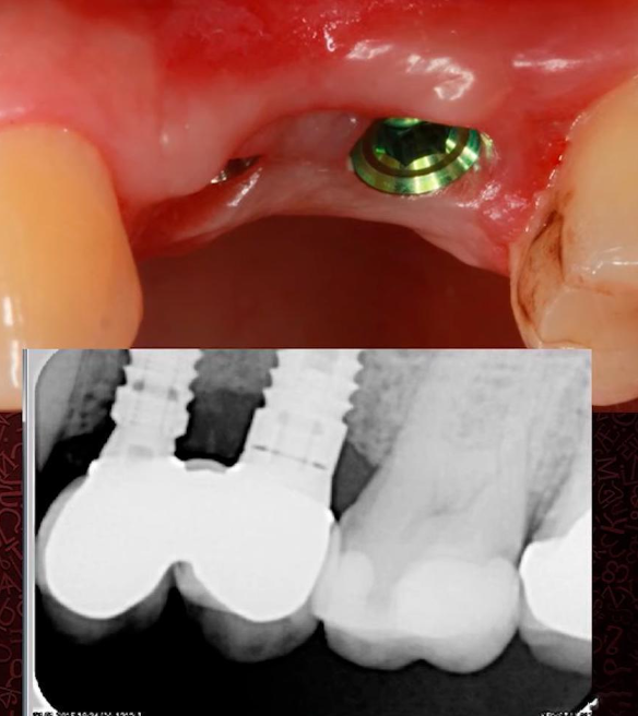 Implant images and radiograph of an already placed restoration with a complex eruption profile