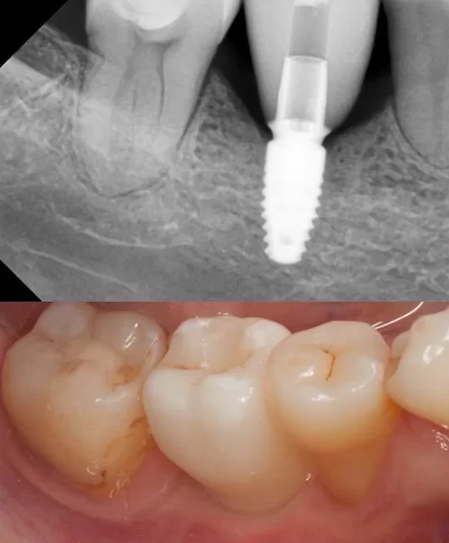 Deep implant with a smooth eruption profile