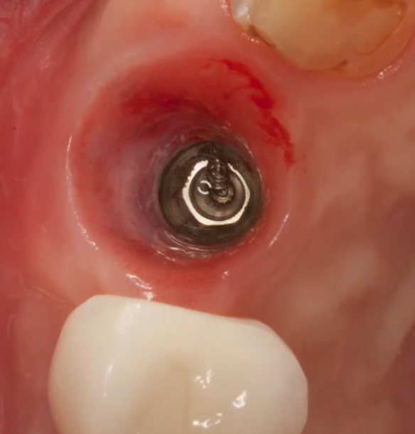 Gingival cuff around a deeply installed implant
