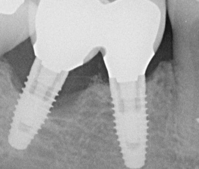 Example of surrounding tissue problems for a high penetration angle implant