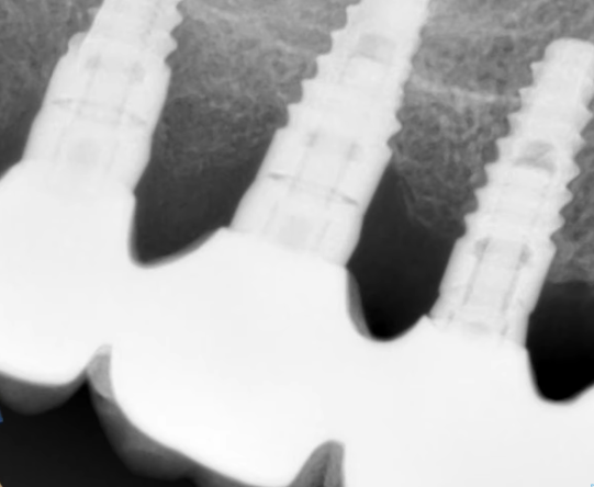 Multiple restorations, where the angle of penetration of the restoration and the degree of bone loss in the mid-implant area can be clearly seen