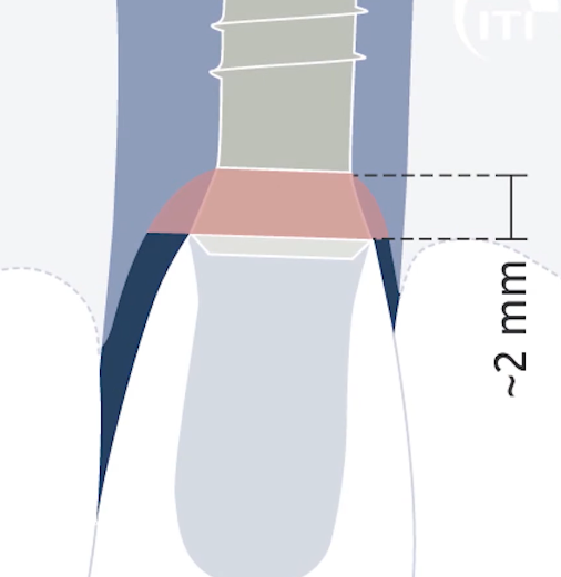 Width of the milled part of the implant of the tissue level type