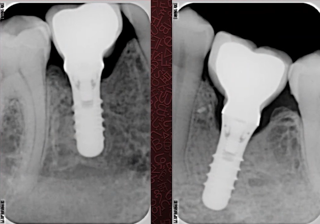 Features of the subcrestal installation of non-submerged tissue level implants