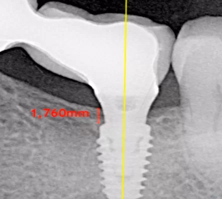 Example of subcrestal implant placement 1. 76 mm below the marginal bone level