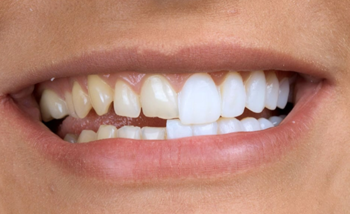 The most popular dental procedures in the us: from implants to whitening