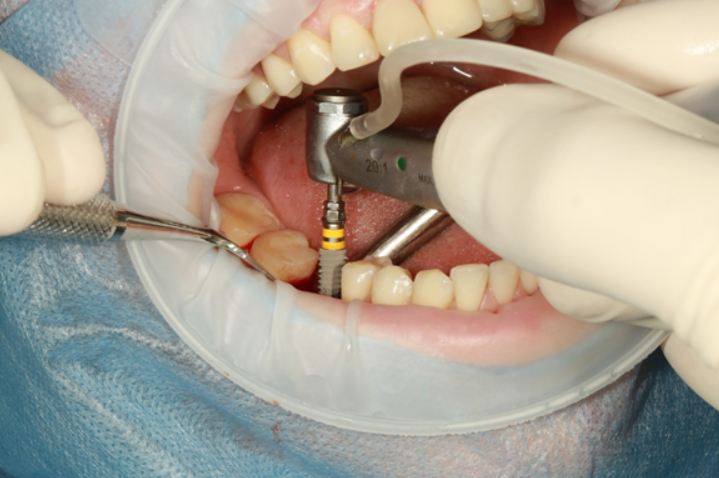 What are the most common dental treatment