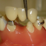 Dental implantation in systemic diseases: opportunities and limitations