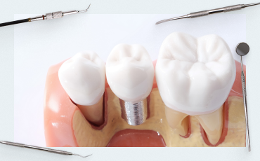 Soft tissue integration part 6. What to do if there are problems with attached keratinized gingiva