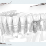 How long can an implant last? A review of a 20-year clinical study of patients who received fixed titanium implant restorations