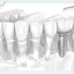 How long can an implant last? A review of a 20-year clinical study of patients who received fixed titanium implant restorations