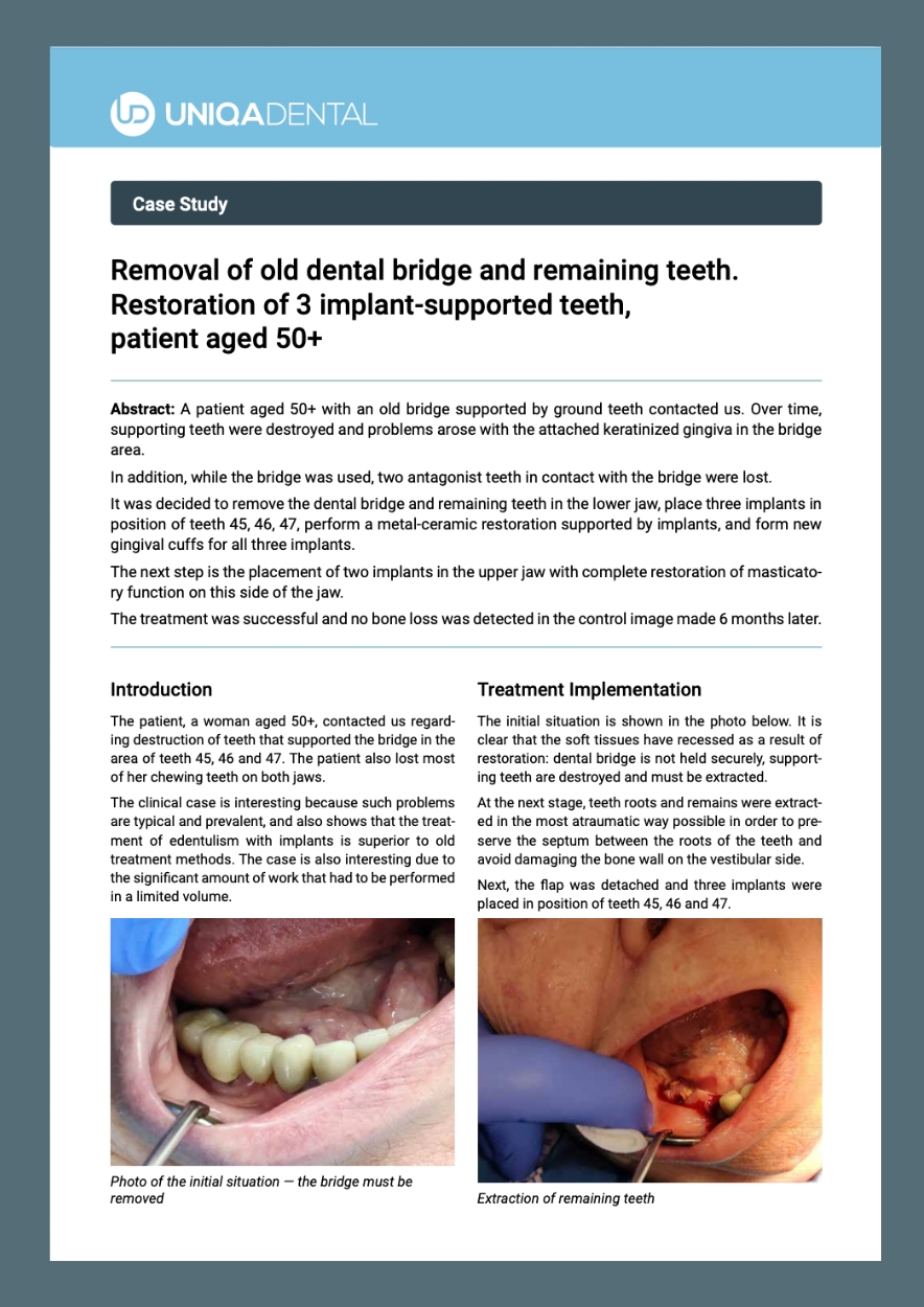 Removal of old dental bridge and remaining teeth. Restoration of 3 implant-supported teeth, patient aged 50+ (PDF)