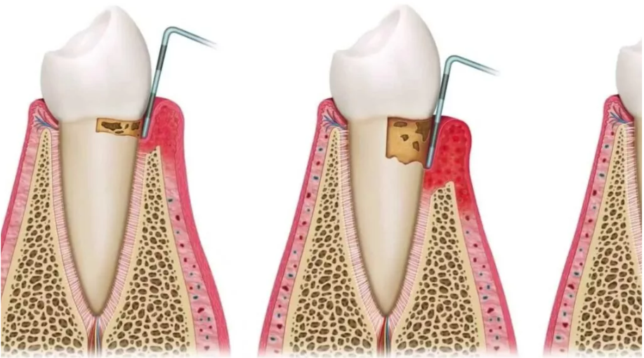 The impact of psychological stress on gum diseases