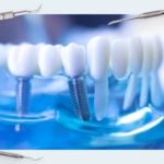 What are full-arch dental implants?