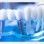 What are full-arch dental implants?