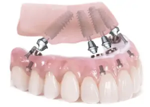 A model of the upper and lower jaw with dental implants inserted, highlighting the precision and fit of the implants.