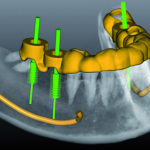 How do modern implant-supported restorations differ from similar ones made without CAD/CAM technologies: advanced methods of restoring teeth using implants