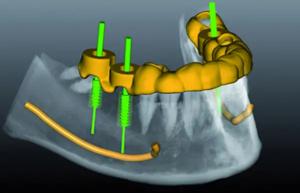 How do modern implant-supported restorations differ from similar ones made without CAD/CAM technologies: advanced methods of restoring teeth using implants