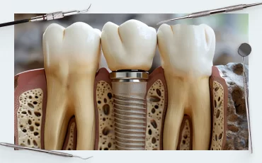 Reosseointegration of the implant. <br></noscript>Can a rotated implant “take root”?