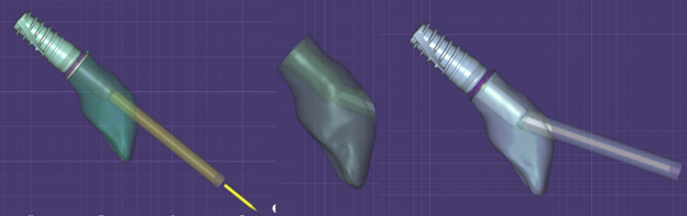 Modeling the exit of the screw channel in the crown