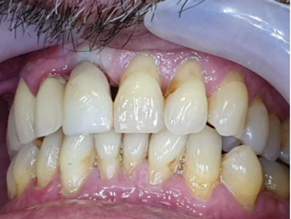 Is it necessary to use a Ti base? Different types of dental parts & digital impression